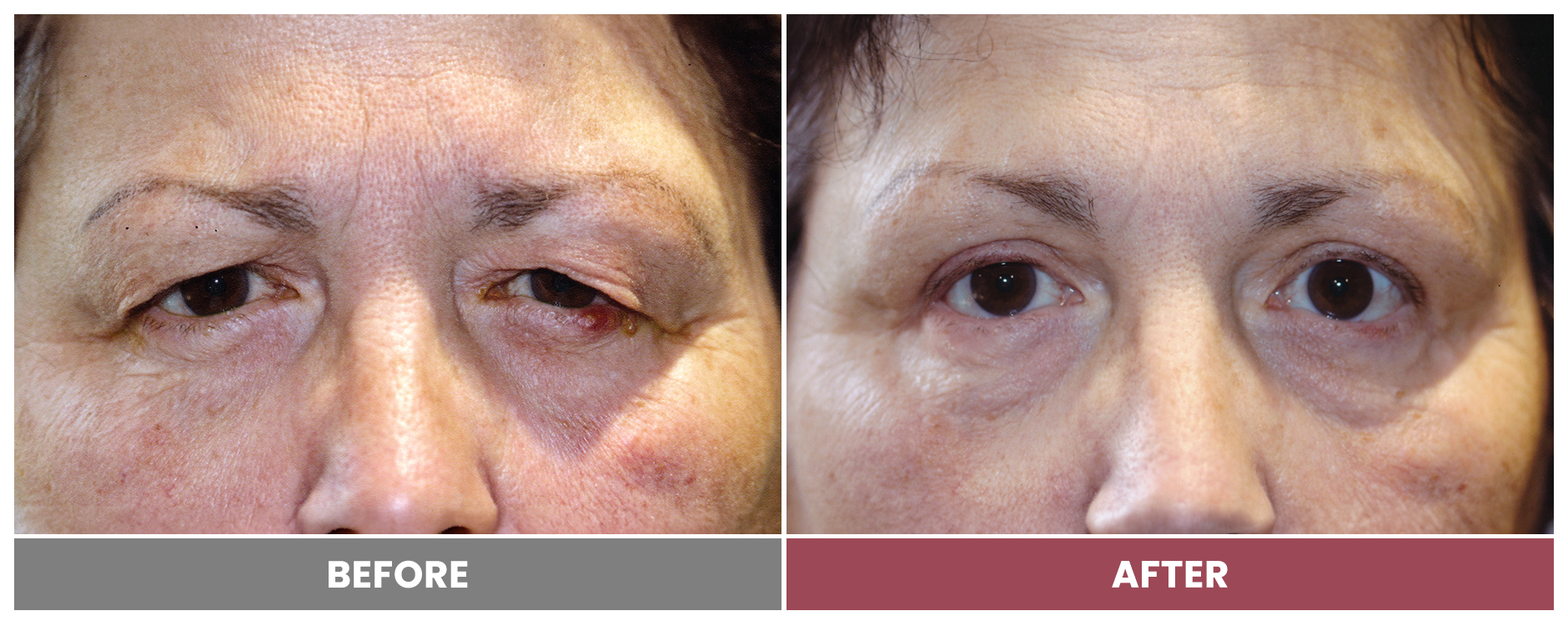 Upper Blepharoplasty - Case 46